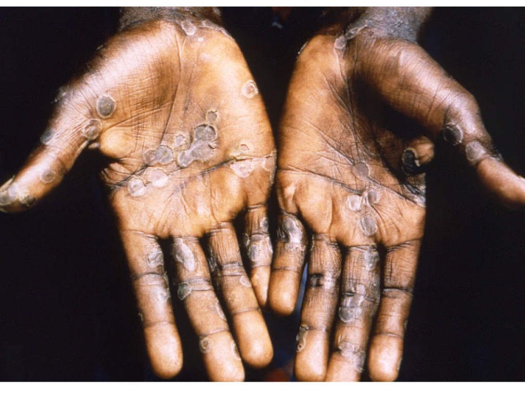 Les mains d’un patient touché par la « variole du singe ». (image d’illustration. © CDC/IMAGE POINT FR/BSIP via AFP
